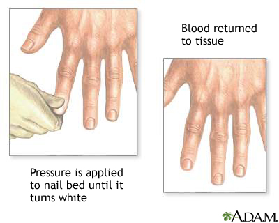 Illustrated capilary refill test showing hands