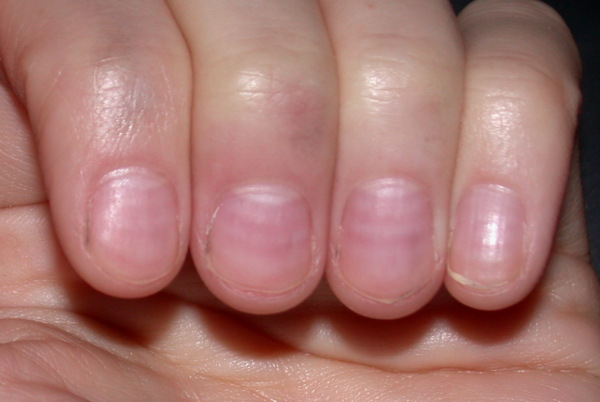 the abnormal nail beds of a person with scleroderma. Lines that can be seen underneath the nailheads in addition to the ridges in nails.
